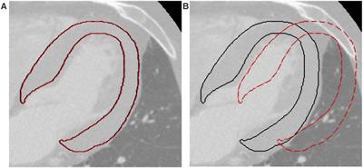 A robust radiomic-based machine learning approach to detect cardiac amyloidosis using cardiac computed tomography